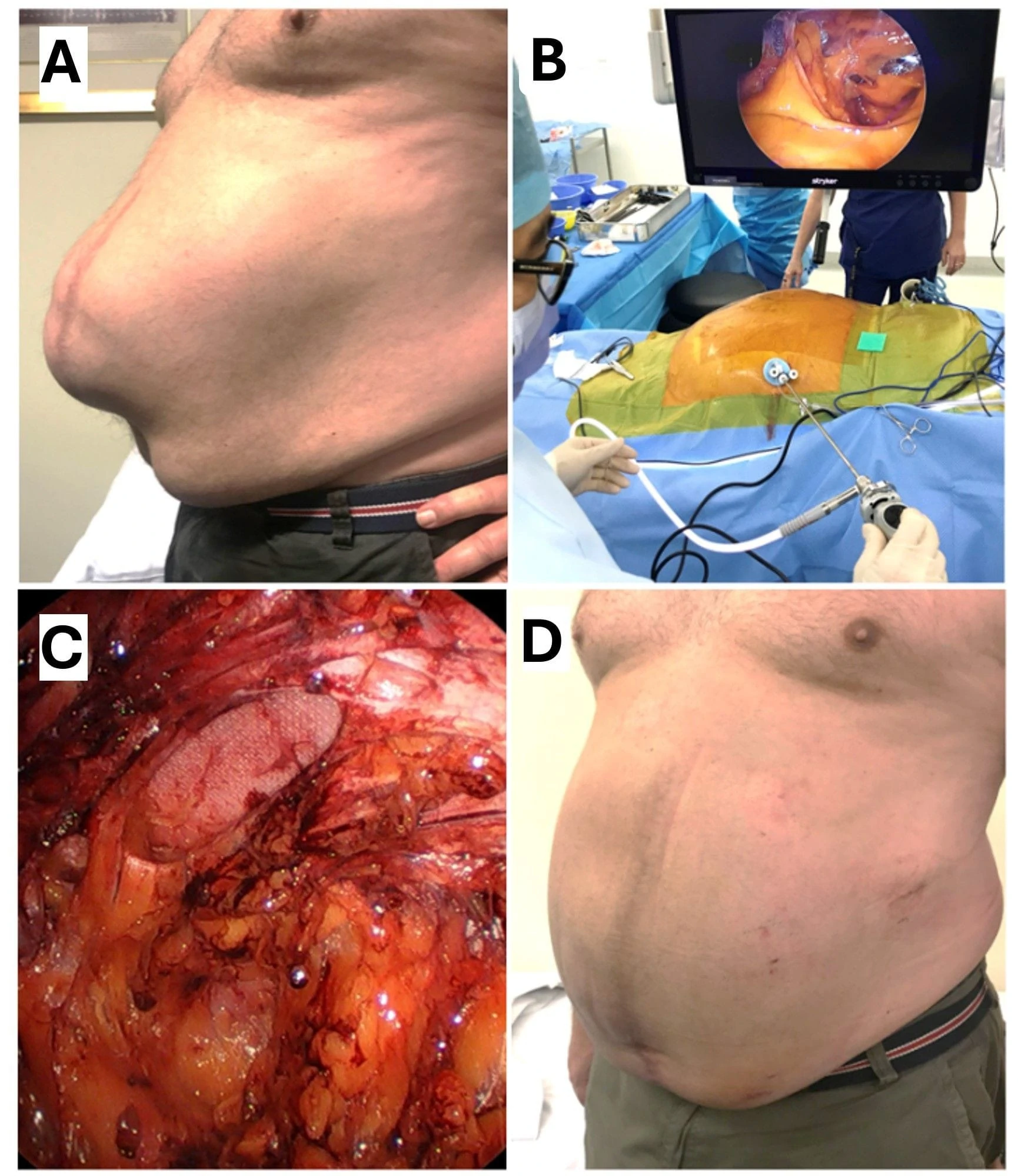 Ventral hernia repair before and after