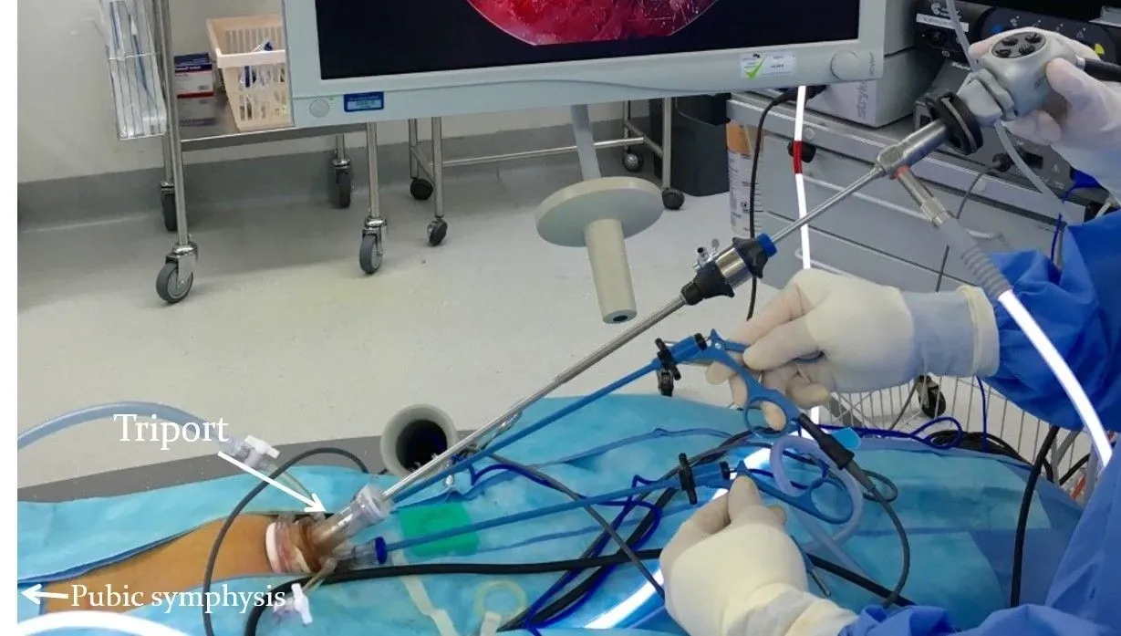 Single-incision TEP triport device for inguinal hernia repair