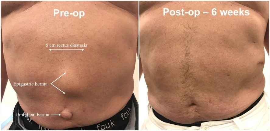 Rectus diastasis repair before and after — 6 weeks post-op