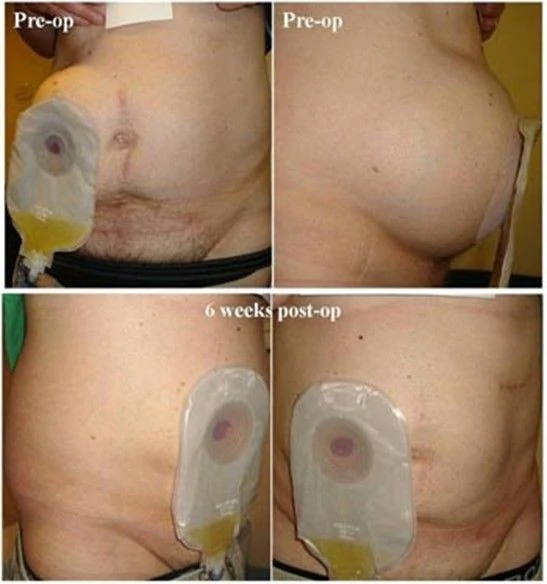 Parastomal hernia before and after repair