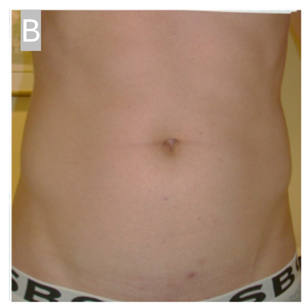 Rectus diastasis repair — post-op result