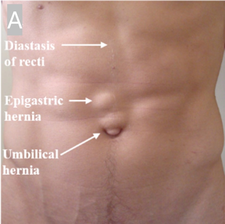 Pre-op: rectus diastasis, epigastric hernia and umbilical hernia