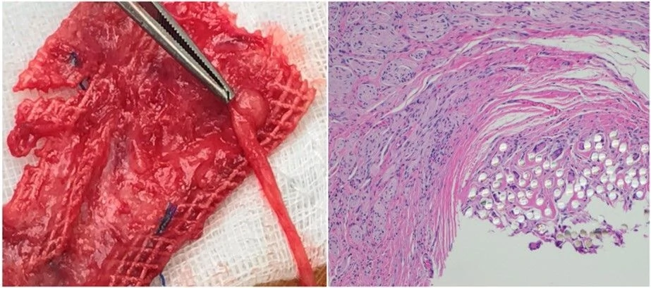 Nerve specimen removed during chronic pain treatment