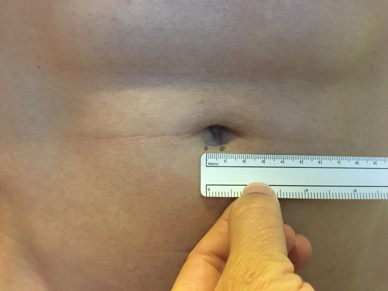 Near-invisible umbilical hernia repair scar